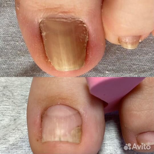 Педикюр медицинский / подолог