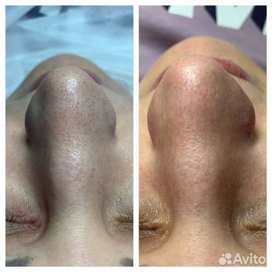 Чистка лица + Пилинг