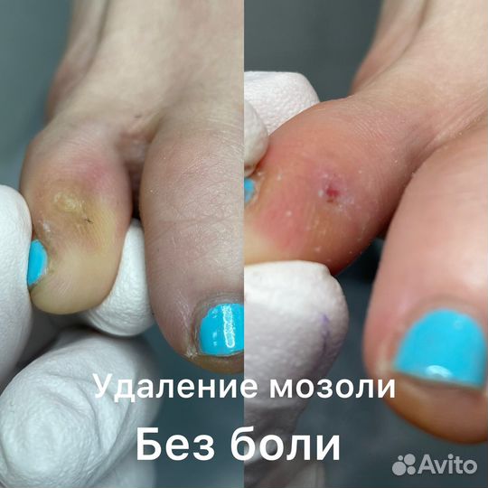 Удаление мозоли подолог Одинцово