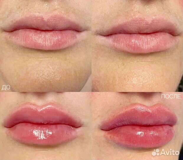 Биоревитализация