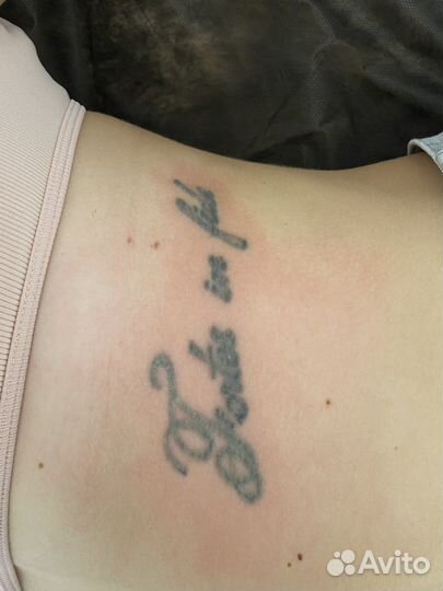 Лазерное удаление тату татуажа