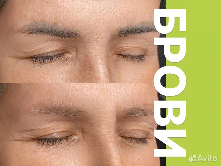 Лазерное удаление татуировок и татуажа