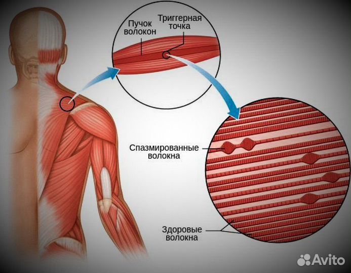 Миопрессура-Юмейхо-Йога