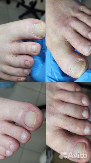 Педикюр подолог