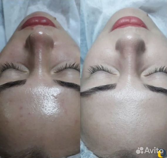 Чистка лица