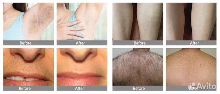 Аппарат для лазерной эпиляции Maxtery с обучением