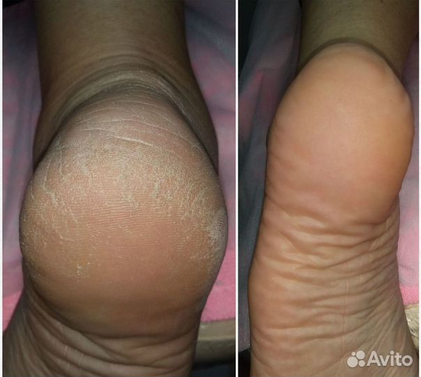 Парамедицинский педикюр