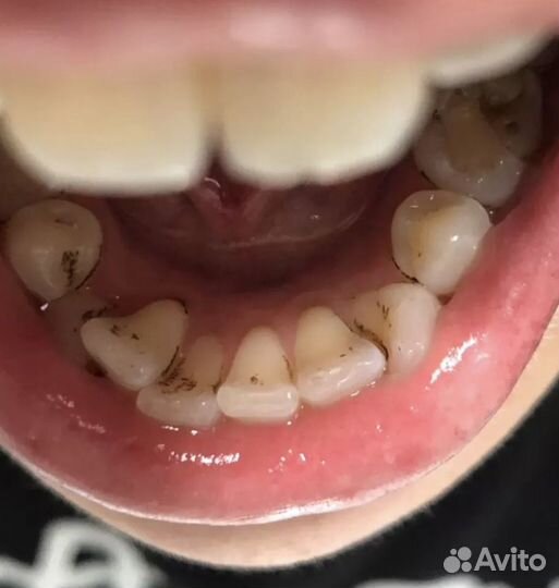 4) Ультразвуковое устройство для чистки зубов