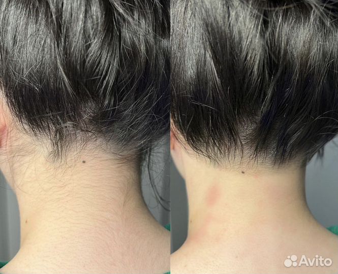 Элос эпиляция