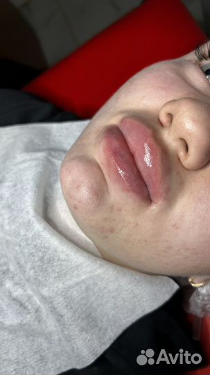 Увеличение губ