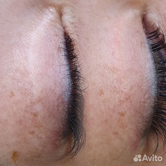 Дермопигментация, камуфляж шрамов