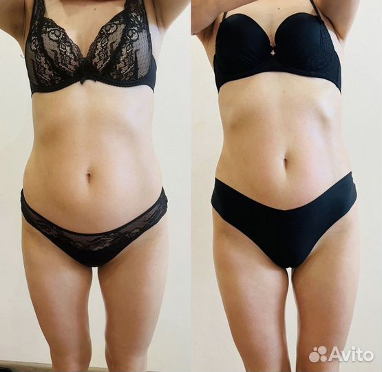 Антицеллюлитный массаж. LPG массаж. Похудение