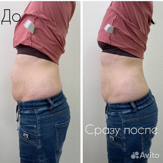 Коррекция фигуры не требующая курса(липосоникс)