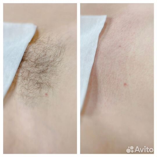 Шугаринг Воск чмр