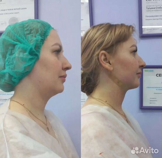 Услуги косметолога, ринопластика, липоредукция