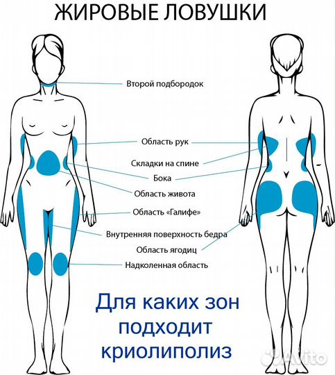 Криолиполиз, смас-липосакция