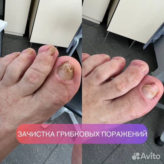 Лечебный педикюр подолог маникюр