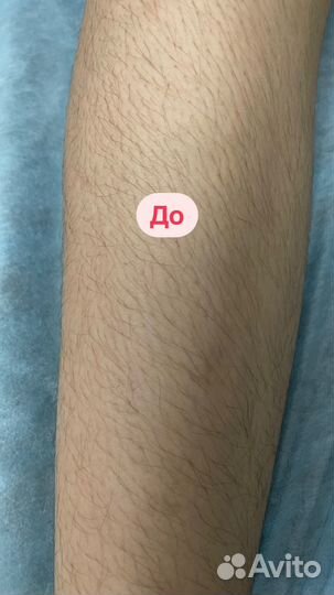 Электроэпиляция