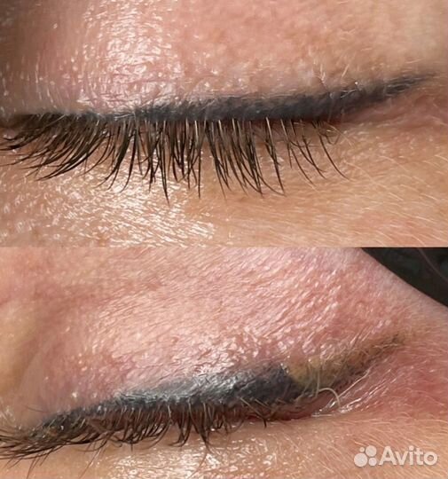 Удаление татуажа татуировок лазером ремувером