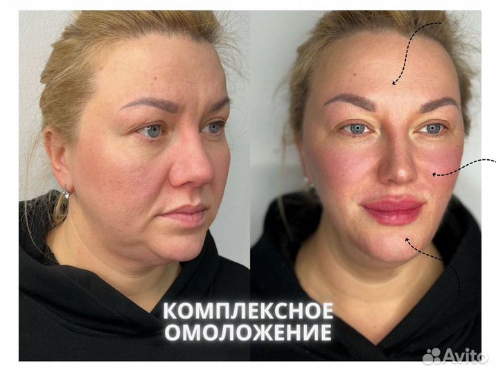 Комплексная программа омоложения лица