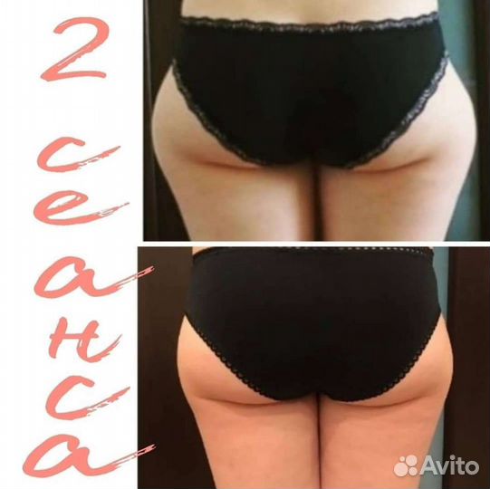 Ручная липосакция