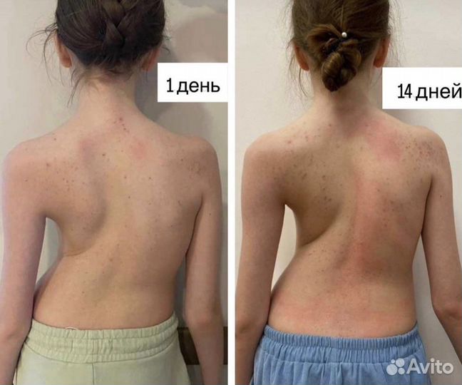 Лечение сколиоза/грыжи/сутулости и др