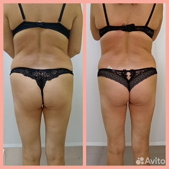 Антицеллюлитный массаж ручной