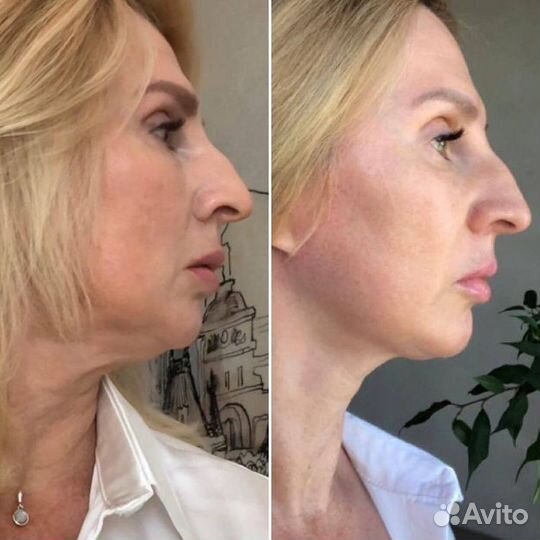 Элос Омоложение и Эпиляция