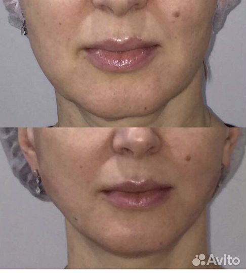 Коррекция нижней трети лица