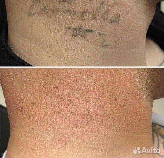 Удаление тату(Лазером)