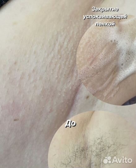 Восковая депиляция