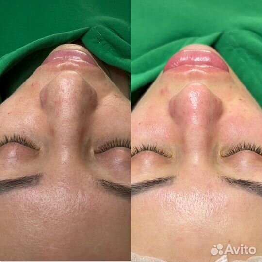 Косметолог чистка лица пилинг