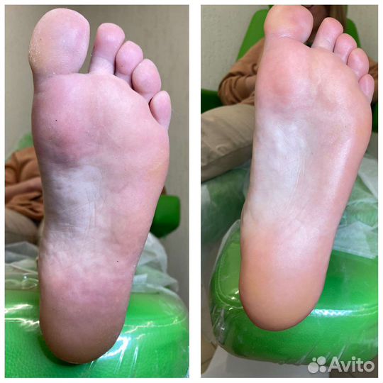 Аппаратный педикюр, комбинированный педикюр