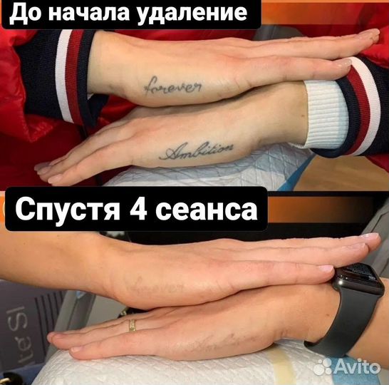 «Лазерное удаление Тату / Татуажа, пм»