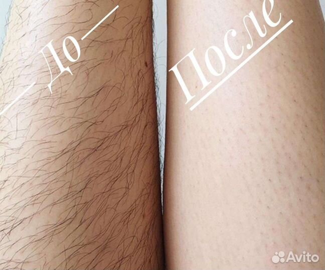 Лазерная эпиляция (элос) все тело