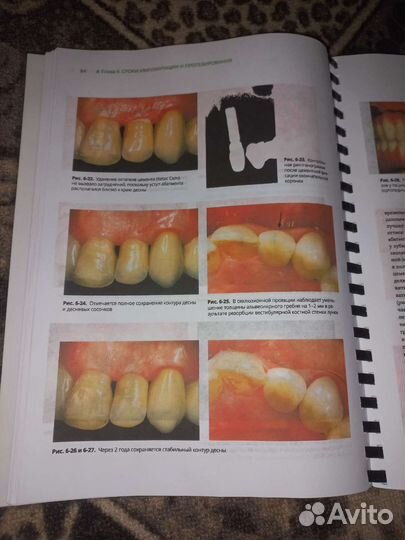 Протезирование с опорой на имплантаты книга