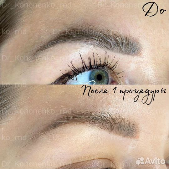 Удаление татуажа бровей