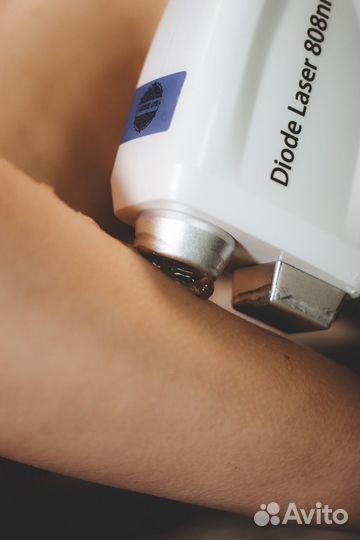 Лазерная эпиляция