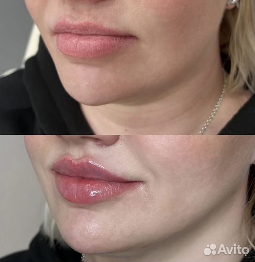 Обучение косметологии ботокс нити. Гос.диплом