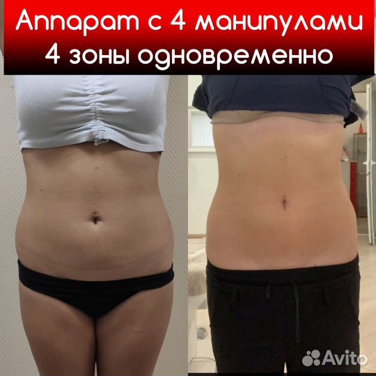 Криолиполиз процедура