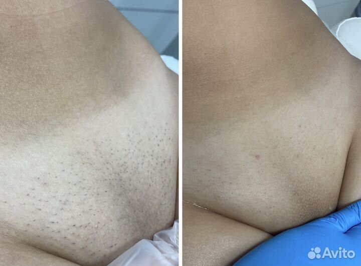 Лазерная эпиляция