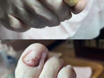 Лечение грибков на ногтях