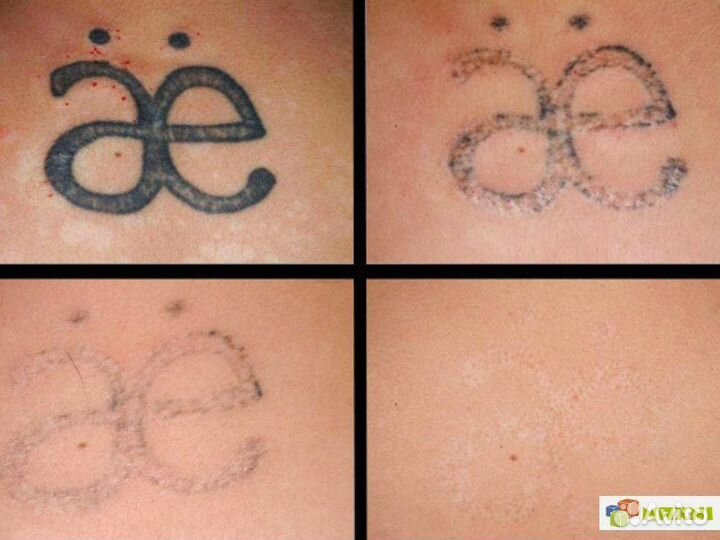 Удаление тату(Лазером)
