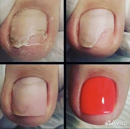 Педикюр,Подолог. Протезирование ногтей