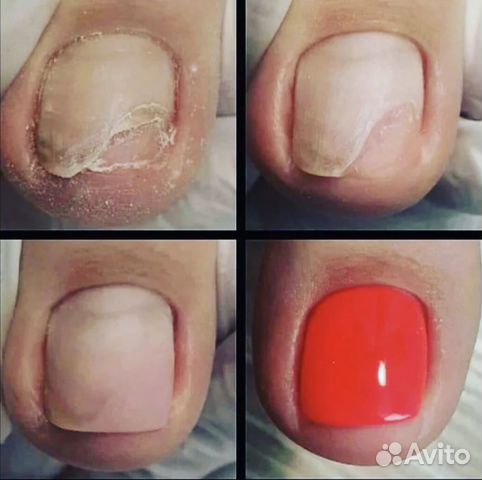 Педикюр,Подолог. Протезирование ногтей