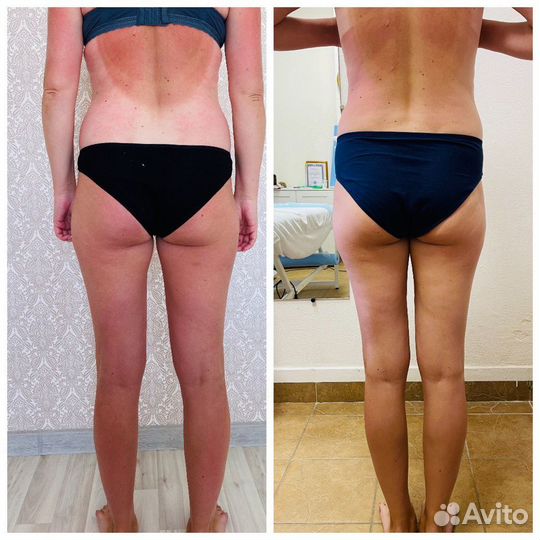 LPG массаж/Сфера