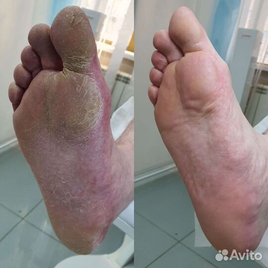 Педикюр, подолог, трещины,натоптыши,грибок и т.д