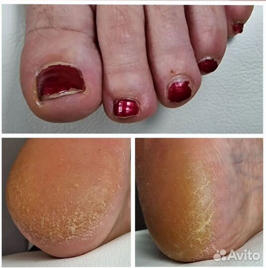 Педикюр на дому