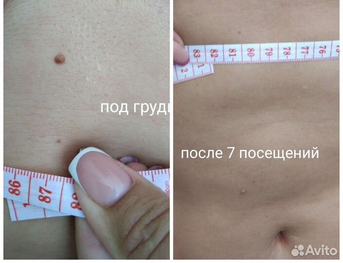 Антицеллюлитный ручной массаж