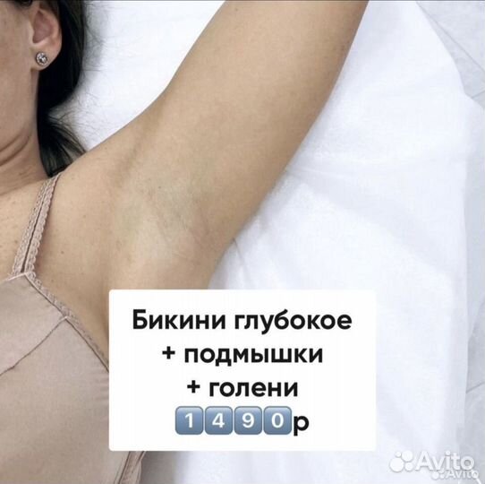 Лазерная эпиляция